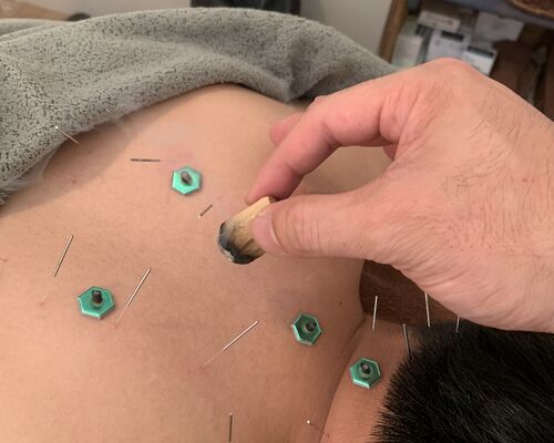 鍼灸施術